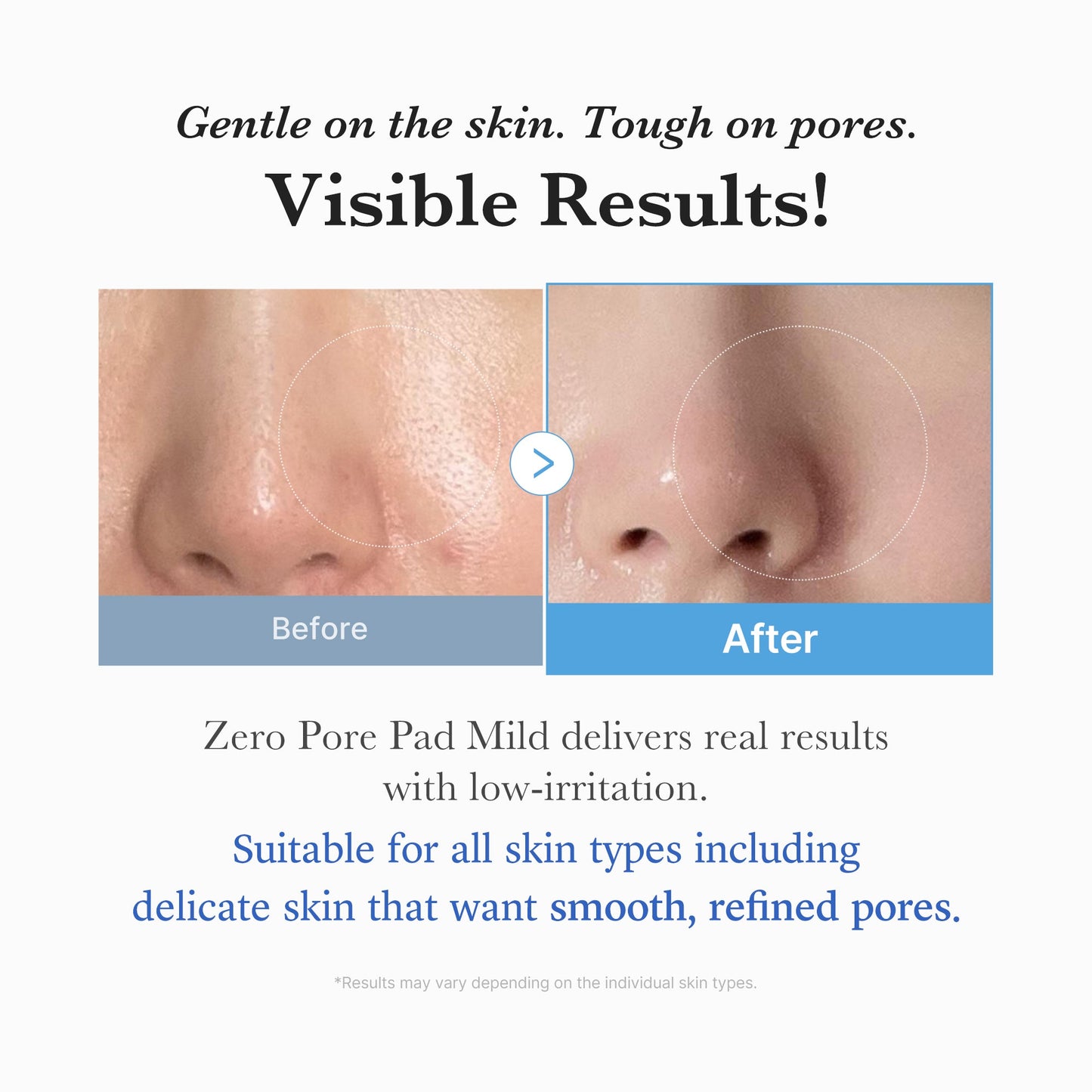 Zero Pore Madecassoside Pads Mild for Gentle Daily Toning Care